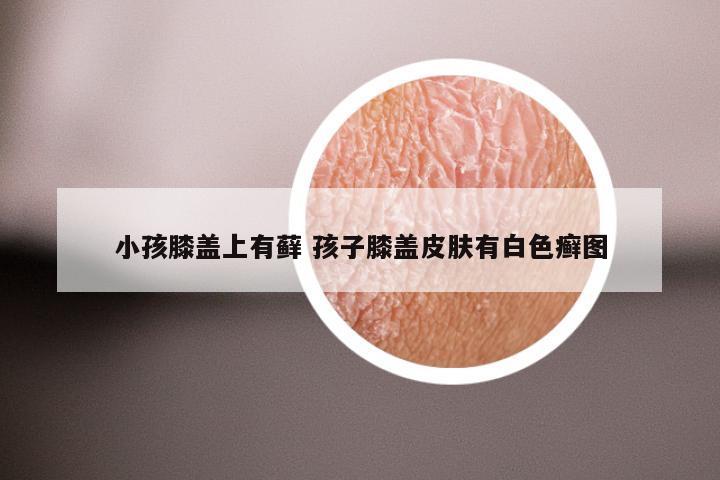 小孩膝盖上有藓 孩子膝盖皮肤有白色癣图
