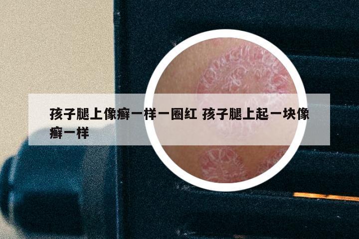 孩子腿上像癣一样一圈红 孩子腿上起一块像癣一样