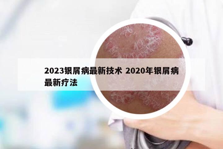 2023银屑病最新技术 2020年银屑病最新疗法