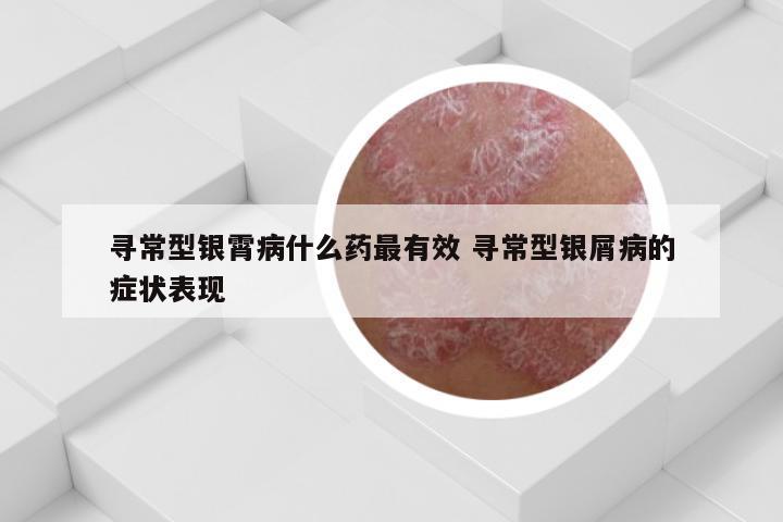 寻常型银霄病什么药最有效 寻常型银屑病的症状表现