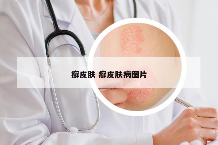 癣皮肤 癣皮肤病图片