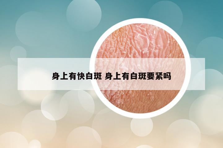 身上有快白斑 身上有白斑要紧吗