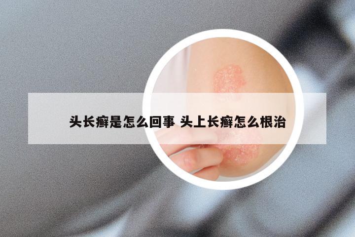 头长癣是怎么回事 头上长癣怎么根治