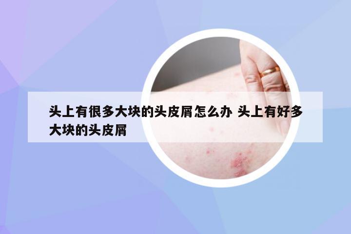 头上有很多大块的头皮屑怎么办 头上有好多大块的头皮屑