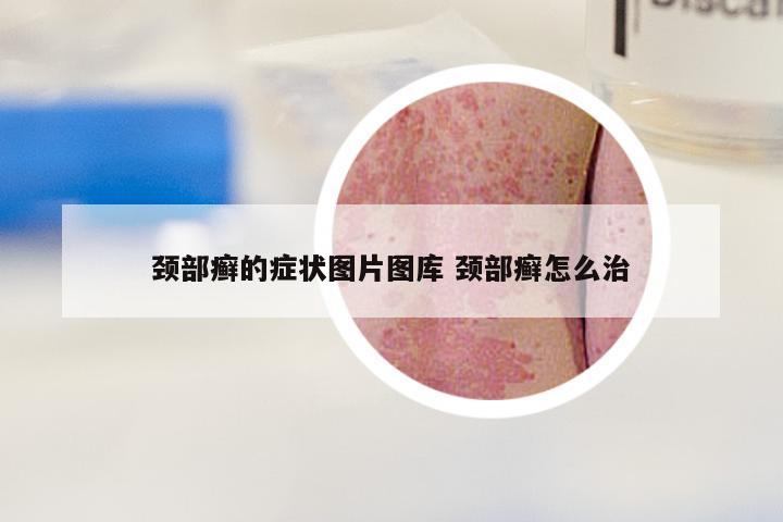 颈部癣的症状图片图库 颈部癣怎么治
