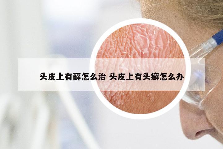 头皮上有藓怎么治 头皮上有头癣怎么办