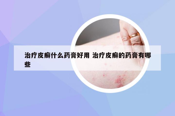 治疗皮癣什么药膏好用 治疗皮癣的药膏有哪些