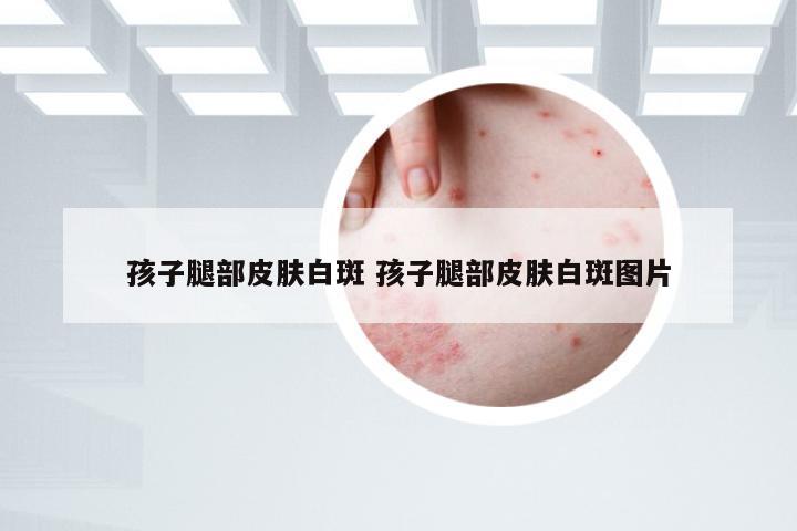 孩子腿部皮肤白斑 孩子腿部皮肤白斑图片