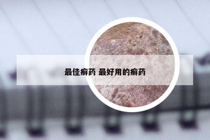 最佳癣药 最好用的癣药