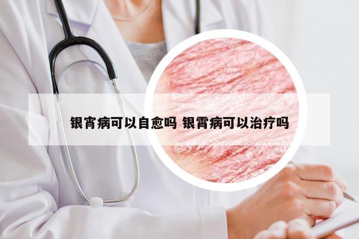 银宵病可以自愈吗 银霄病可以治疗吗