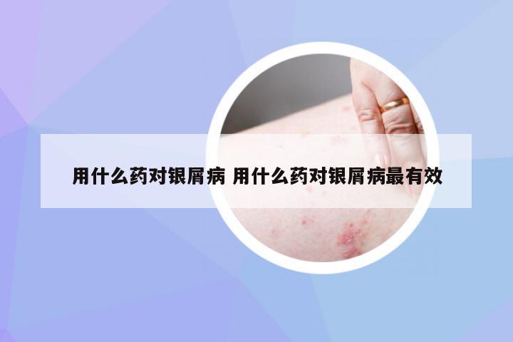 用什么药对银屑病 用什么药对银屑病最有效