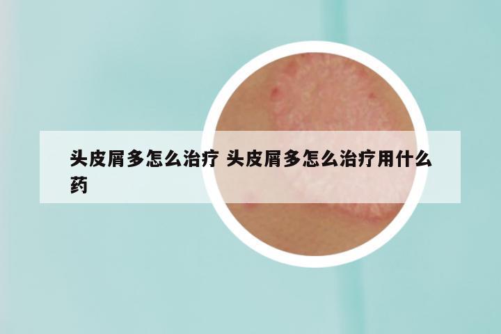 头皮屑多怎么治疗 头皮屑多怎么治疗用什么药