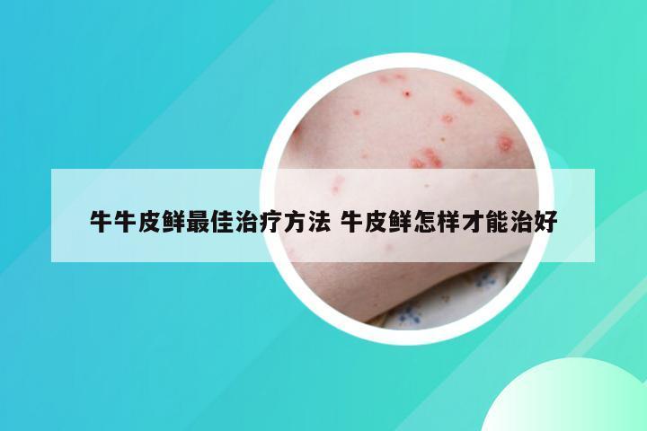 牛牛皮鲜最佳治疗方法 牛皮鲜怎样才能治好