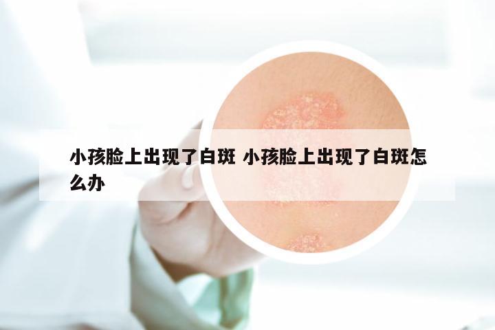 小孩脸上出现了白斑 小孩脸上出现了白斑怎么办