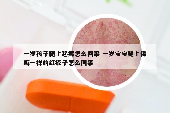 一岁孩子腿上起癣怎么回事 一岁宝宝腿上像癣一样的红疹子怎么回事