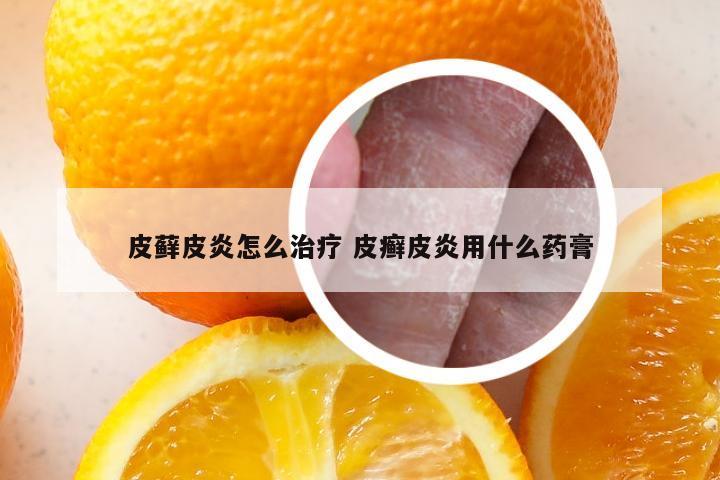 皮藓皮炎怎么治疗 皮癣皮炎用什么药膏