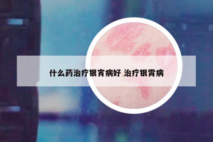 什么药治疗银宵病好 治疗银霄病