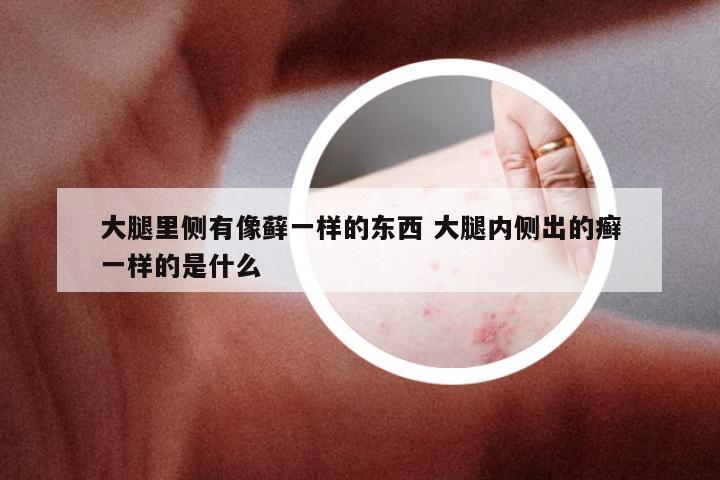 大腿里侧有像藓一样的东西 大腿内侧出的癣一样的是什么