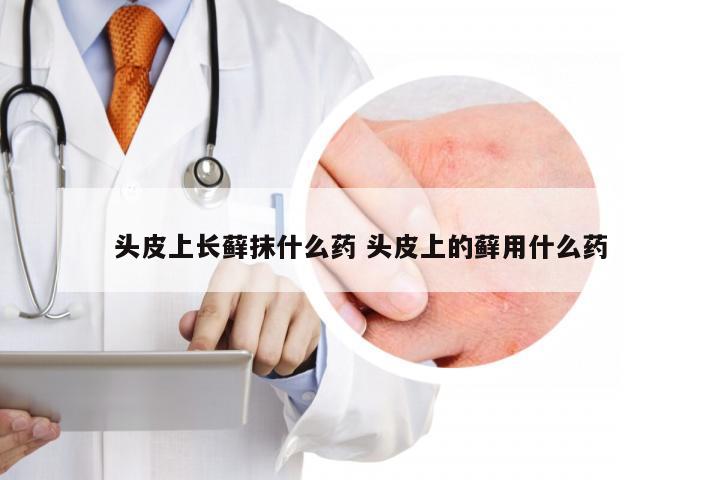 头皮上长藓抹什么药 头皮上的藓用什么药