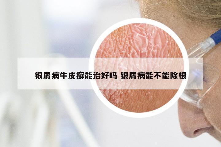 银屑病牛皮癣能治好吗 银屑病能不能除根
