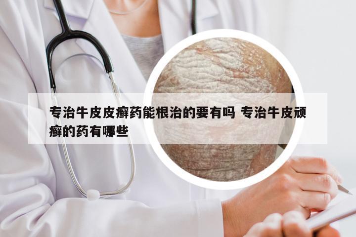 专治牛皮皮癣药能根治的要有吗 专治牛皮顽癣的药有哪些