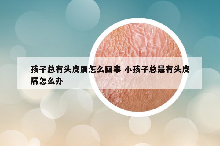 孩子总有头皮屑怎么回事 小孩子总是有头皮屑怎么办
