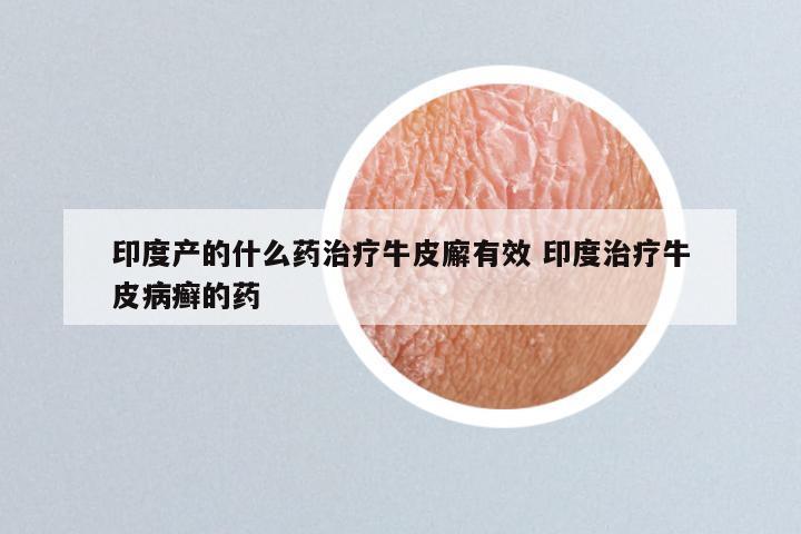 印度产的什么药治疗牛皮廨有效 印度治疗牛皮病癣的药