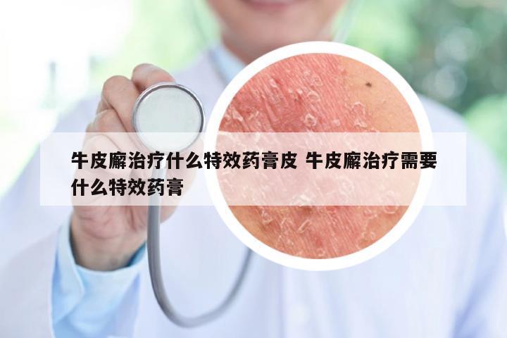 牛皮廨治疗什么特效药膏皮 牛皮廨治疗需要什么特效药膏