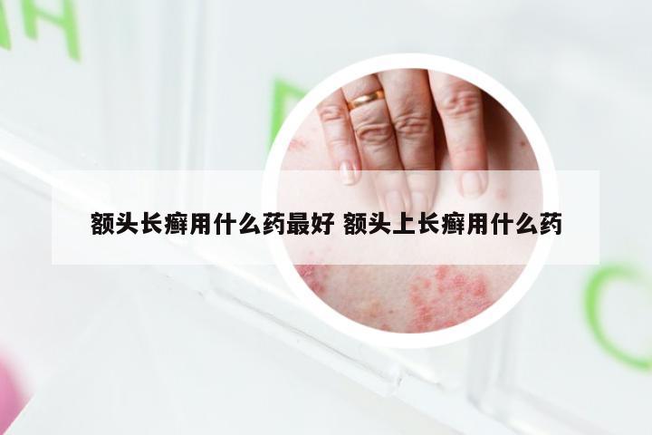 额头长癣用什么药最好 额头上长癣用什么药