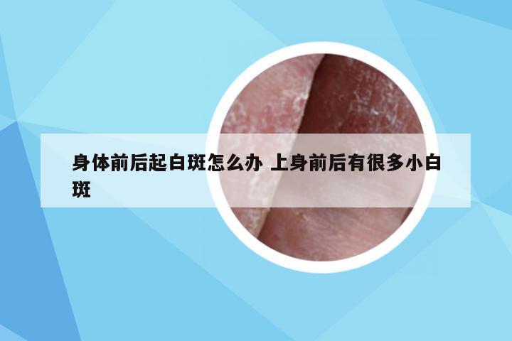身体前后起白斑怎么办 上身前后有很多小白斑