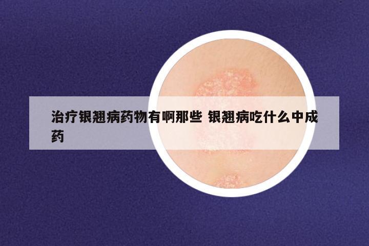 治疗银翘病药物有啊那些 银翘病吃什么中成药