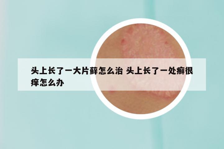 头上长了一大片藓怎么治 头上长了一处癣很痒怎么办