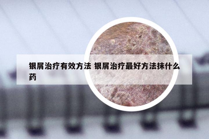 银屑治疗有效方法 银屑治疗最好方法抹什么药