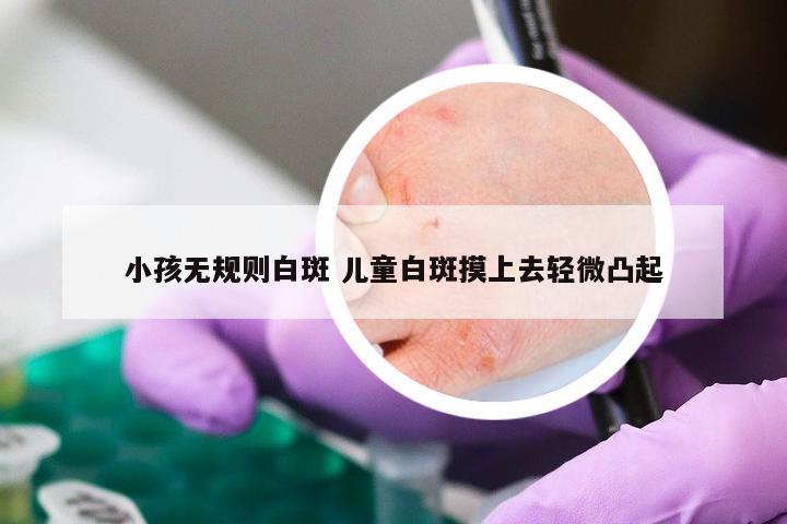 小孩无规则白斑 儿童白斑摸上去轻微凸起