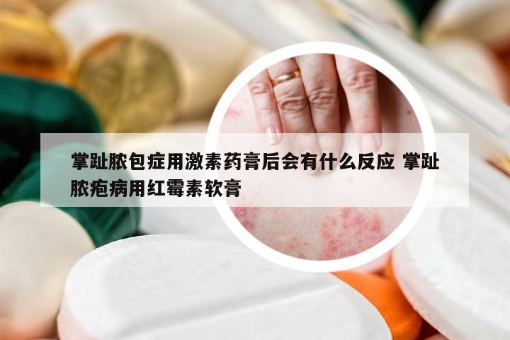 掌趾脓包症用激素药膏后会有什么反应 掌趾脓疱病用红霉素软膏