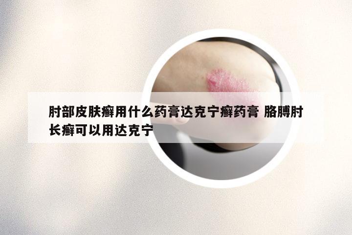 肘部皮肤癣用什么药膏达克宁癣药膏 胳膊肘长癣可以用达克宁