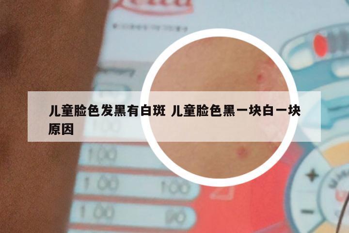 儿童脸色发黑有白斑 儿童脸色黑一块白一块原因