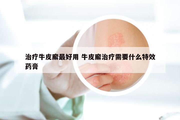 治疗牛皮廨最好用 牛皮廨治疗需要什么特效药膏