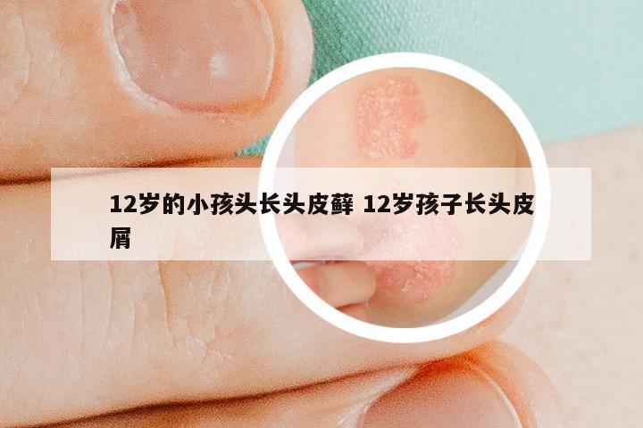 12岁的小孩头长头皮藓 12岁孩子长头皮屑