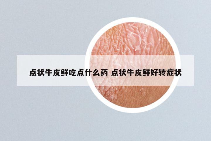 点状牛皮鲜吃点什么药 点状牛皮鲜好转症状