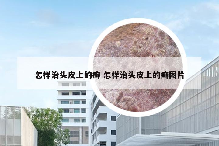 怎样治头皮上的癣 怎样治头皮上的癣图片