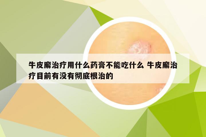 牛皮廨治疗用什么药膏不能吃什么 牛皮廨治疗目前有没有彻底根治的