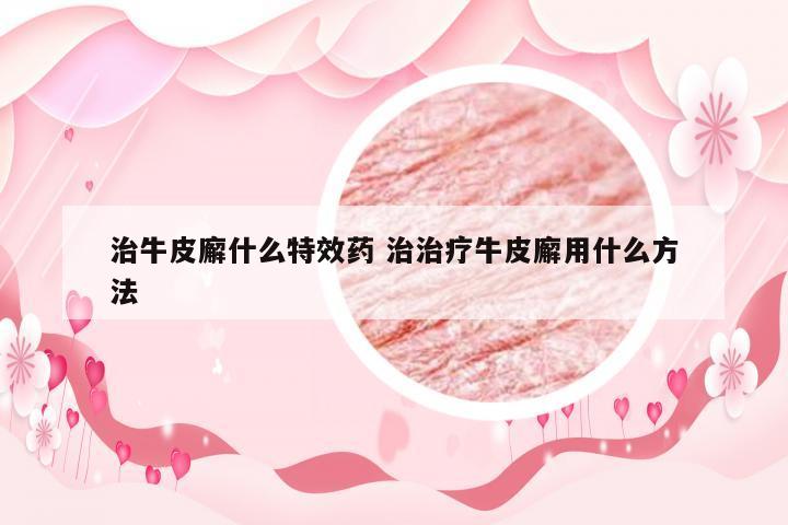 治牛皮廨什么特效药 治治疗牛皮廨用什么方法