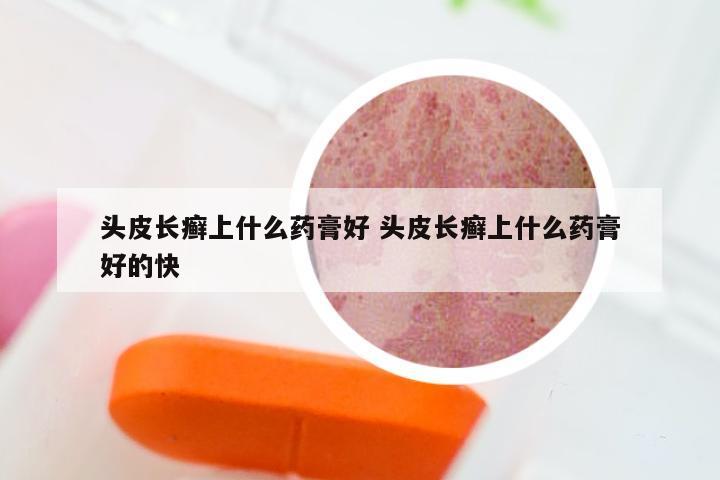 头皮长癣上什么药膏好 头皮长癣上什么药膏好的快