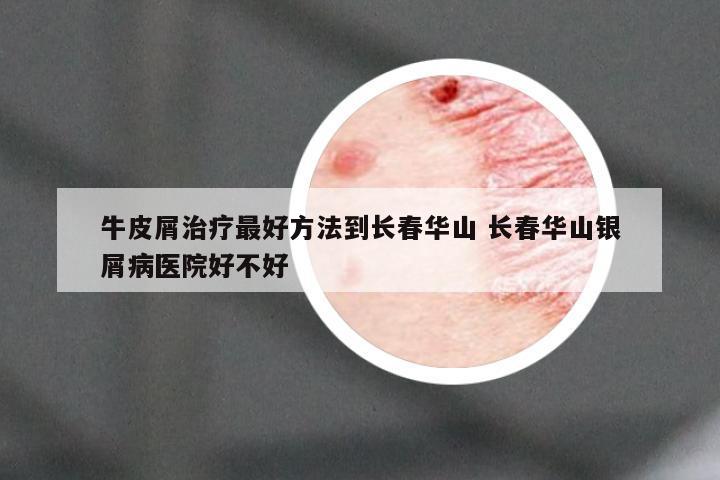 牛皮屑治疗最好方法到长春华山 长春华山银屑病医院好不好