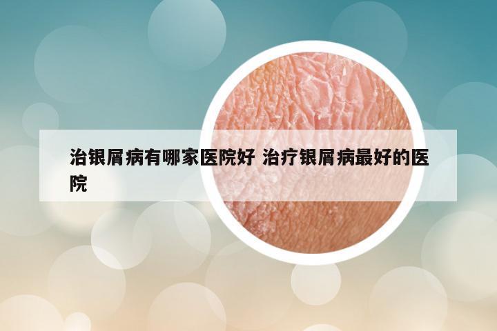 治银屑病有哪家医院好 治疗银屑病最好的医院