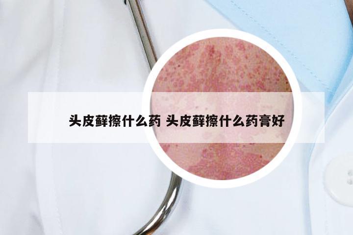 头皮藓擦什么药 头皮藓擦什么药膏好