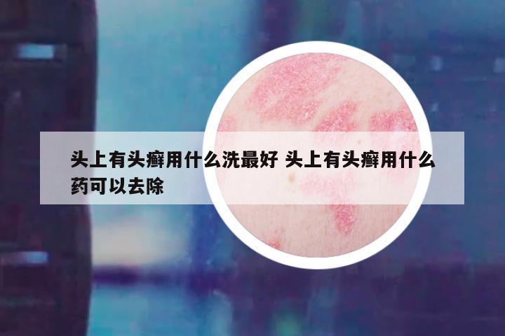 头上有头癣用什么洗最好 头上有头癣用什么药可以去除