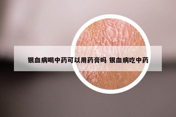 银血病喝中药可以用药膏吗 银血病吃中药