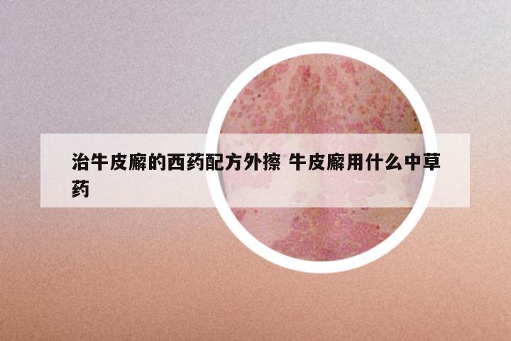 治牛皮廨的西药配方外擦 牛皮廨用什么中草药